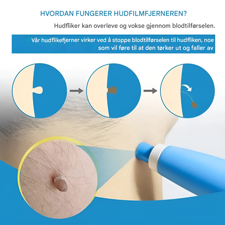 Fjerningssett for hudfliker