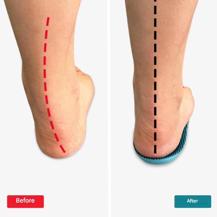 Ortopediske innleggssåler – StepRelief