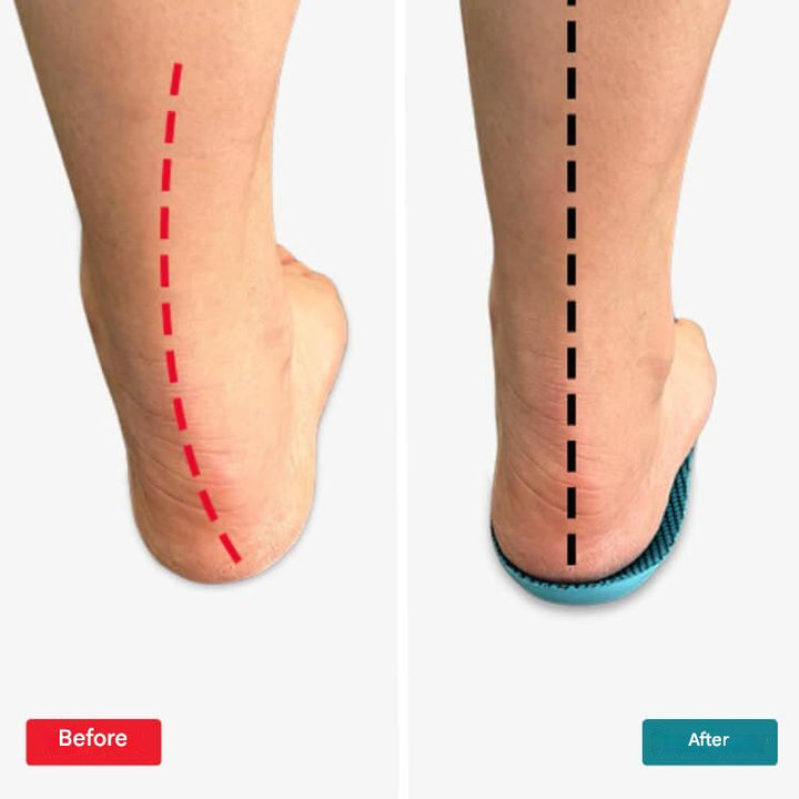 Ortopediske innleggssåler – StepRelief