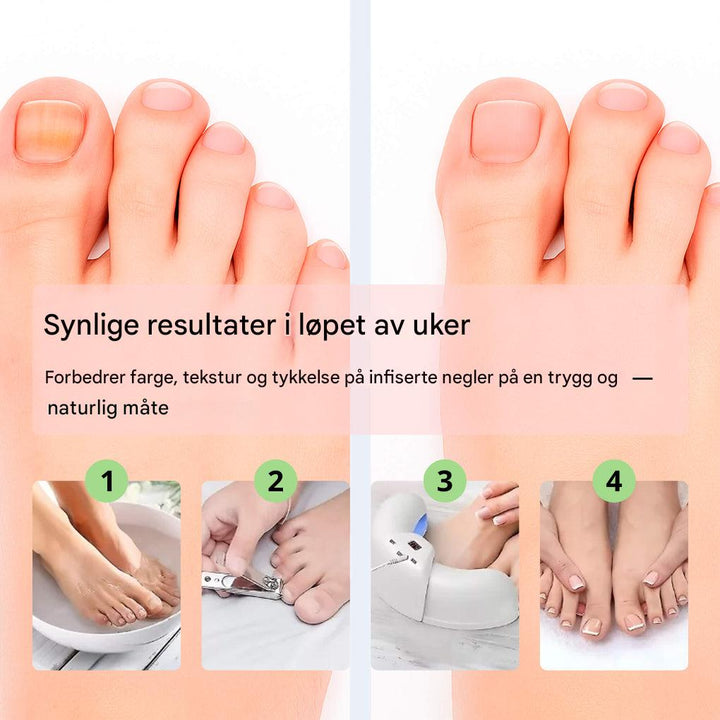 Lasereinheit zur Entfernung von Nagelpilz