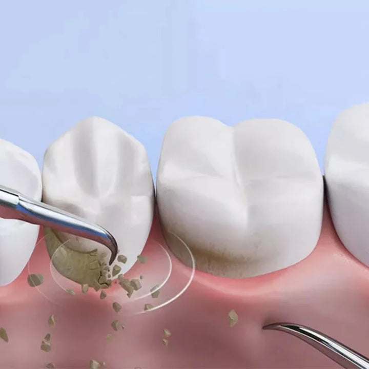 Tool for removal of tartar plaque