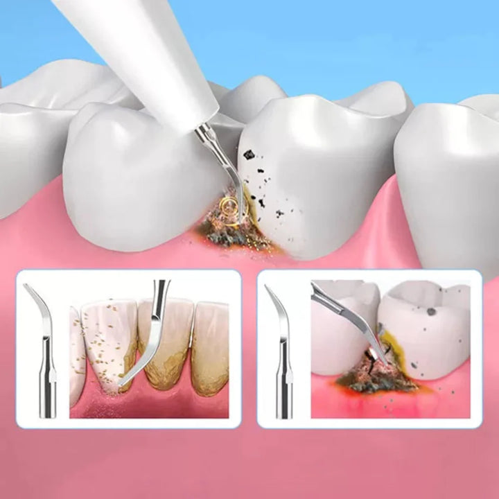 Tool for removal of tartar plaque